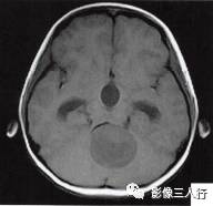 【病例】小脑毛细胞型星形细胞瘤1例MR影像分析 【病例】小脑毛细胞型星形细胞瘤1例MR影像分析