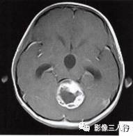 【病例】小脑毛细胞型星形细胞瘤1例MR影像分析 【病例】小脑毛细胞型星形细胞瘤1例MR影像分析