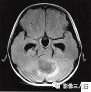【病例】小脑毛细胞型星形细胞瘤1例MR影像分析 【病例】小脑毛细胞型星形细胞瘤1例MR影像分析