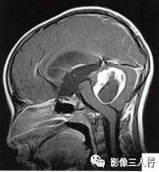 【病例】小脑毛细胞型星形细胞瘤1例MR影像分析 【病例】小脑毛细胞型星形细胞瘤1例MR影像分析