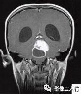 【病例】小脑毛细胞型星形细胞瘤1例MR影像分析 【病例】小脑毛细胞型星形细胞瘤1例MR影像分析