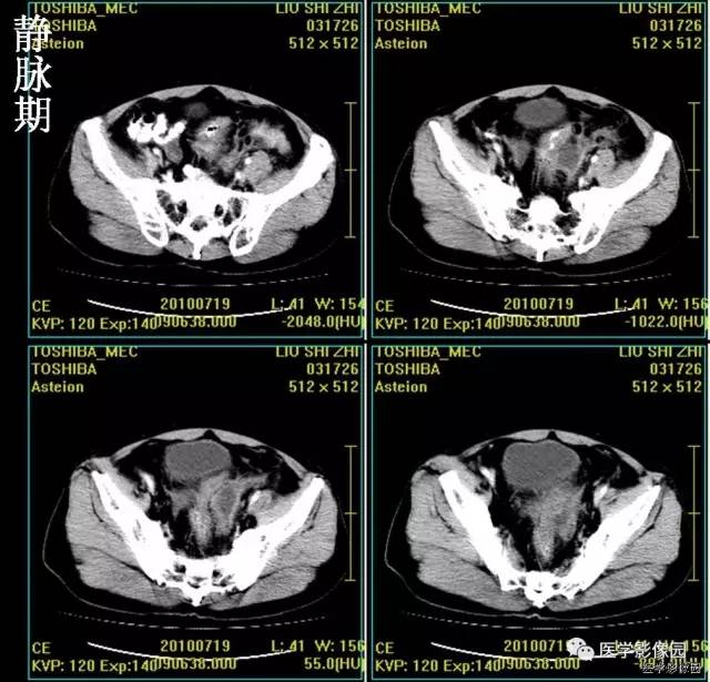 【病例】前列腺癌1例CT影像表现 【病例】前列腺癌1例CT影像表现