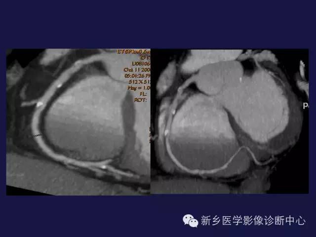 【PPT】64排后时代CT在心血管疾病的应用