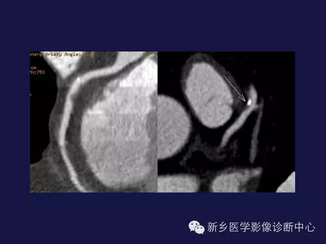 【PPT】64排后时代CT在心血管疾病的应用