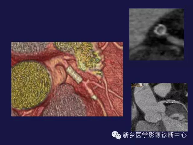 【PPT】64排后时代CT在心血管疾病的应用