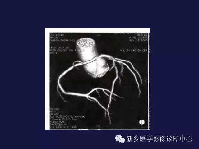 【PPT】64排后时代CT在心血管疾病的应用