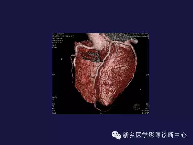 【PPT】64排后时代CT在心血管疾病的应用