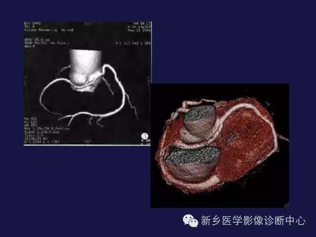 【PPT】64排后时代CT在心血管疾病的应用