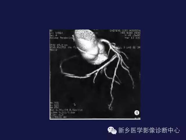 【PPT】64排后时代CT在心血管疾病的应用