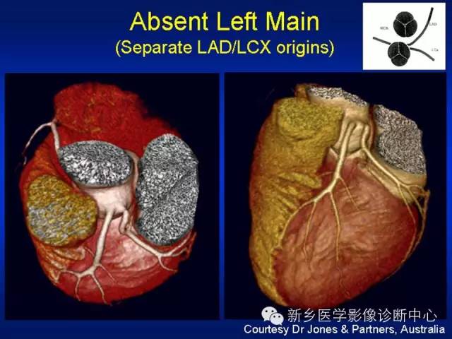 【PPT】64排后时代CT在心血管疾病的应用