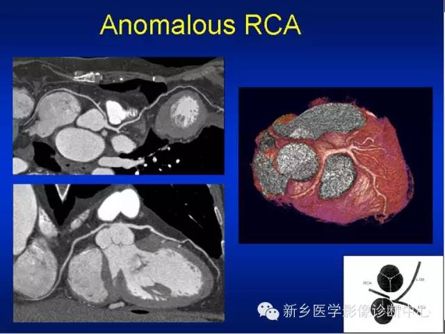【PPT】64排后时代CT在心血管疾病的应用