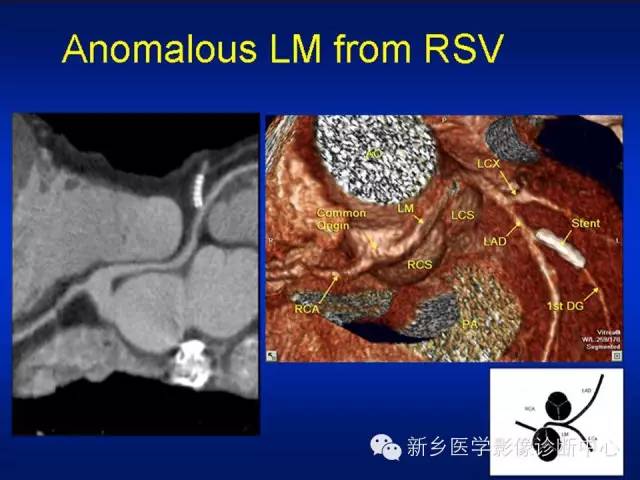 【PPT】64排后时代CT在心血管疾病的应用