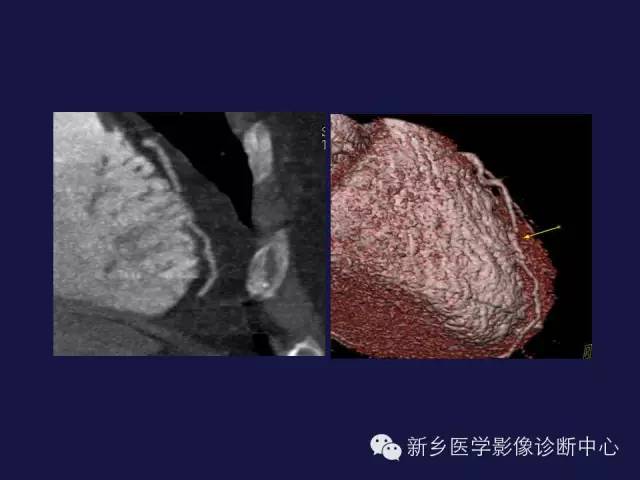 【PPT】64排后时代CT在心血管疾病的应用