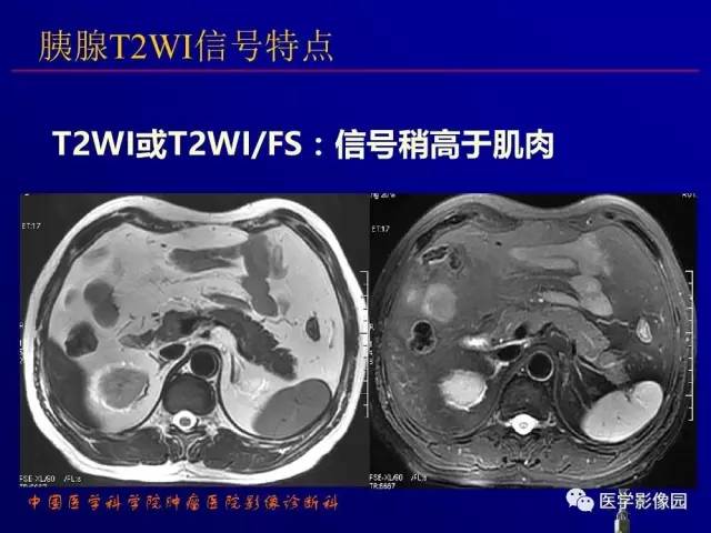 【PPT】胰腺及胆道肿瘤的CT、MRI诊断思路
