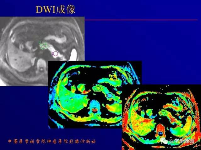 【PPT】胰腺及胆道肿瘤的CT、MRI诊断思路