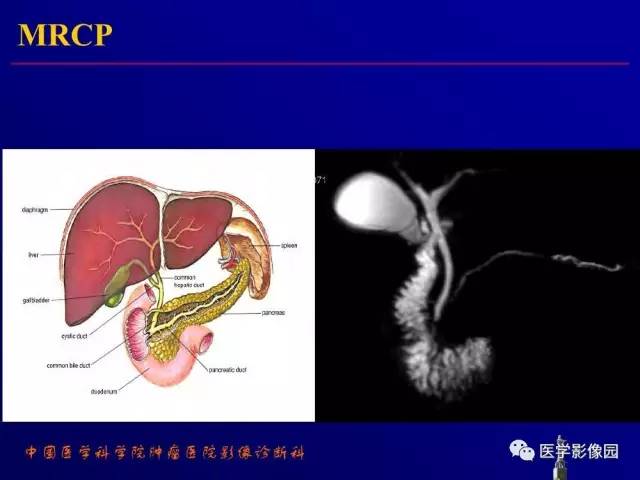 【PPT】胰腺及胆道肿瘤的CT、MRI诊断思路