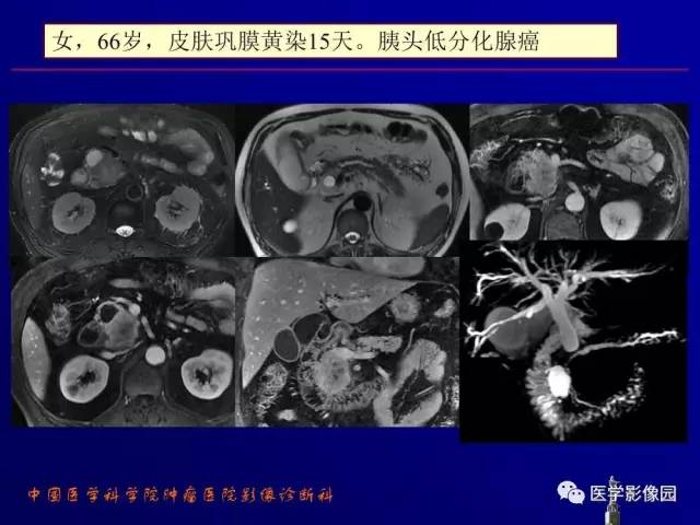 【PPT】胰腺及胆道肿瘤的CT、MRI诊断思路