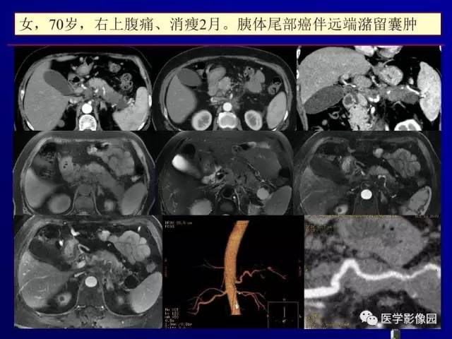 【PPT】胰腺及胆道肿瘤的CT、MRI诊断思路