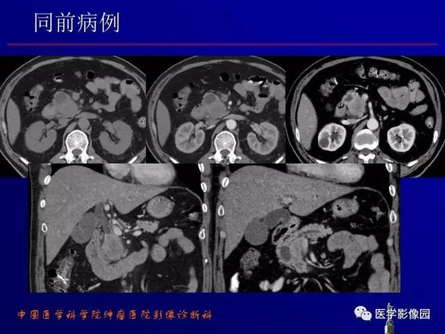 【PPT】胰腺及胆道肿瘤的CT、MRI诊断思路