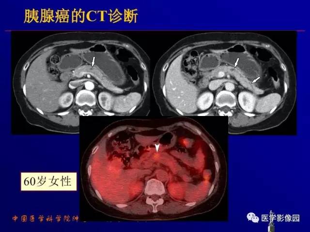 【PPT】胰腺及胆道肿瘤的CT、MRI诊断思路