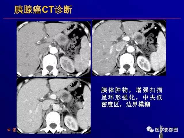 【PPT】胰腺及胆道肿瘤的CT、MRI诊断思路