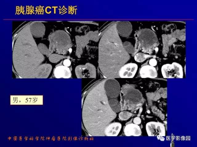 【PPT】胰腺及胆道肿瘤的CT、MRI诊断思路