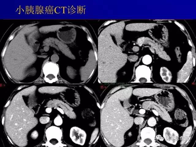 【PPT】胰腺及胆道肿瘤的CT、MRI诊断思路