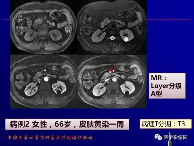 【PPT】胰腺及胆道肿瘤的CT、MRI诊断思路