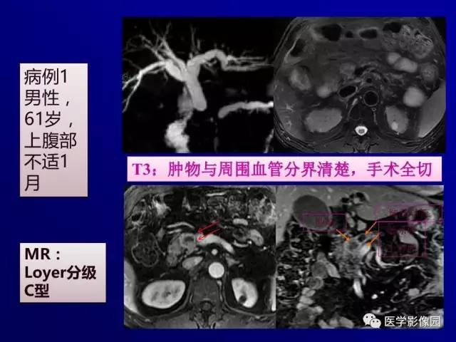【PPT】胰腺及胆道肿瘤的CT、MRI诊断思路