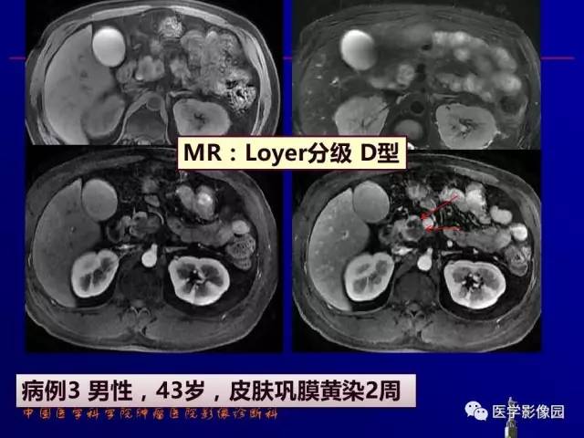 【PPT】胰腺及胆道肿瘤的CT、MRI诊断思路