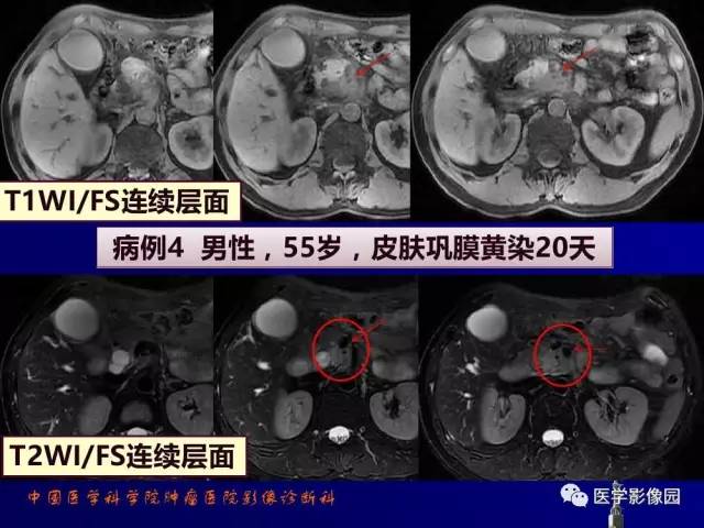 【PPT】胰腺及胆道肿瘤的CT、MRI诊断思路