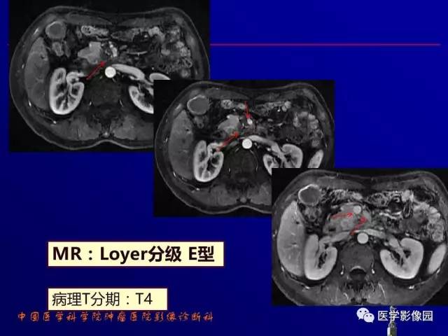 【PPT】胰腺及胆道肿瘤的CT、MRI诊断思路