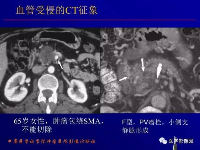 【PPT】胰腺及胆道肿瘤的CT、MRI诊断思路