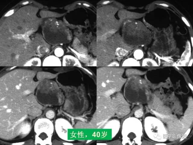 【PPT】胰腺及胆道肿瘤的CT、MRI诊断思路