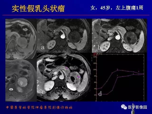 【PPT】胰腺及胆道肿瘤的CT、MRI诊断思路