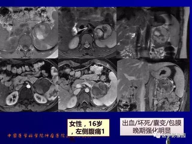 【PPT】胰腺及胆道肿瘤的CT、MRI诊断思路
