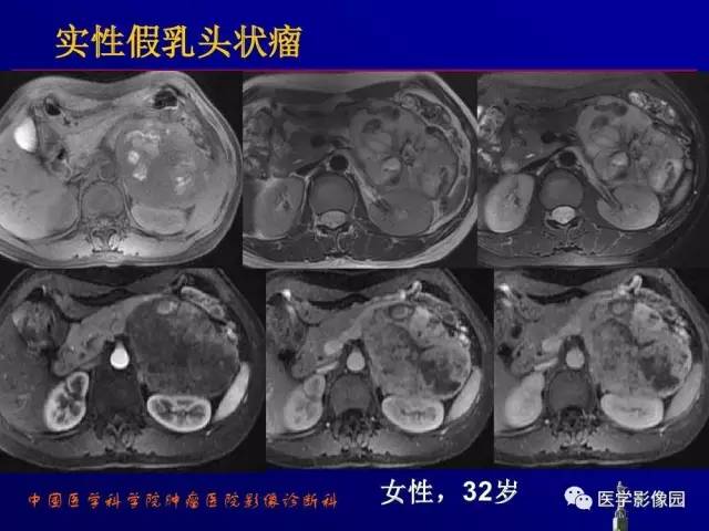 【PPT】胰腺及胆道肿瘤的CT、MRI诊断思路
