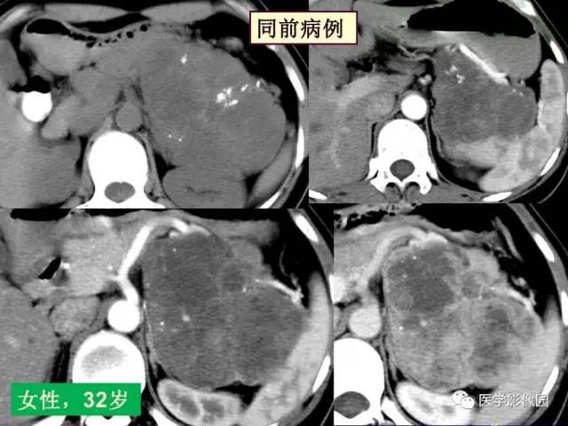 【PPT】胰腺及胆道肿瘤的CT、MRI诊断思路