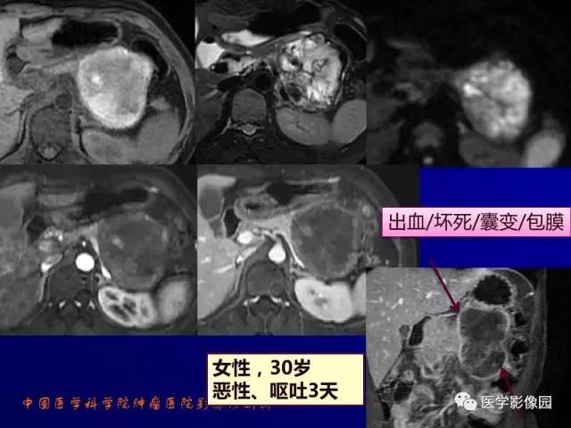【PPT】胰腺及胆道肿瘤的CT、MRI诊断思路