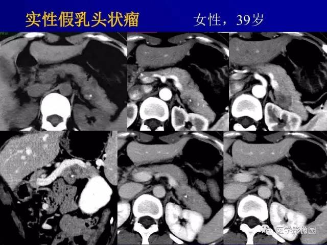 【PPT】胰腺及胆道肿瘤的CT、MRI诊断思路