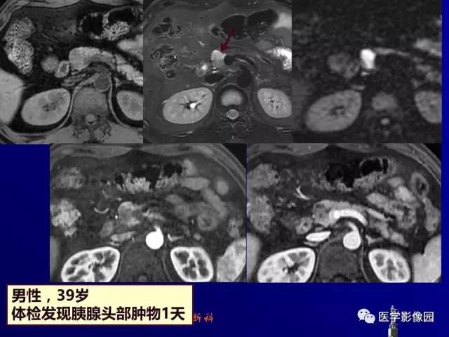 【PPT】胰腺及胆道肿瘤的CT、MRI诊断思路