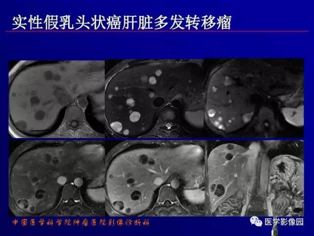 【PPT】胰腺及胆道肿瘤的CT、MRI诊断思路