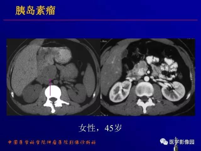 【PPT】胰腺及胆道肿瘤的CT、MRI诊断思路