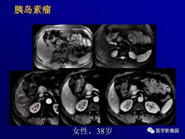 【PPT】胰腺及胆道肿瘤的CT、MRI诊断思路
