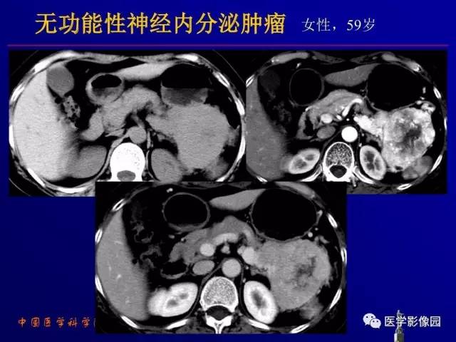 【PPT】胰腺及胆道肿瘤的CT、MRI诊断思路