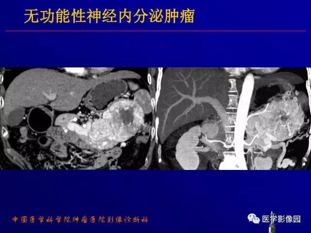 【PPT】胰腺及胆道肿瘤的CT、MRI诊断思路