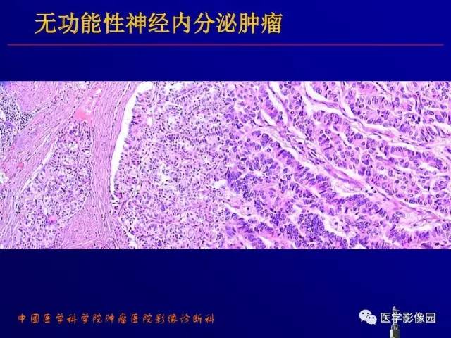 【PPT】胰腺及胆道肿瘤的CT、MRI诊断思路