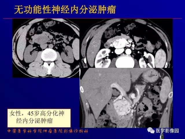 【PPT】胰腺及胆道肿瘤的CT、MRI诊断思路