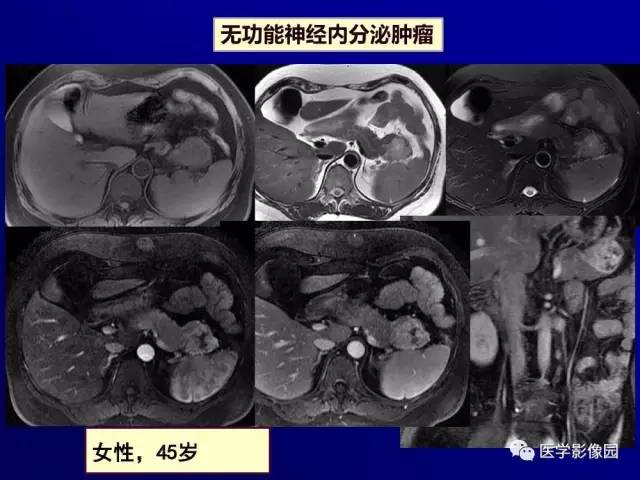 【PPT】胰腺及胆道肿瘤的CT、MRI诊断思路
