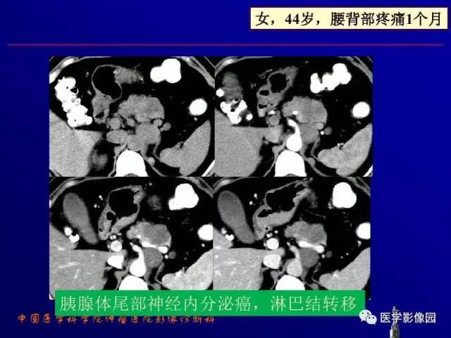 【PPT】胰腺及胆道肿瘤的CT、MRI诊断思路